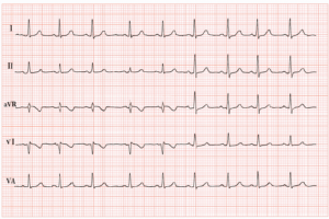 Electrocardiograma Sin Interpretación